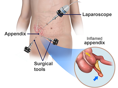 Appendectomy