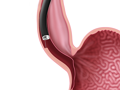 Esophageal Cancer Surgery