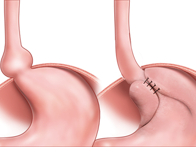 Hiatal Hernia Repair