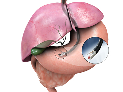 Interventional Endoscopy