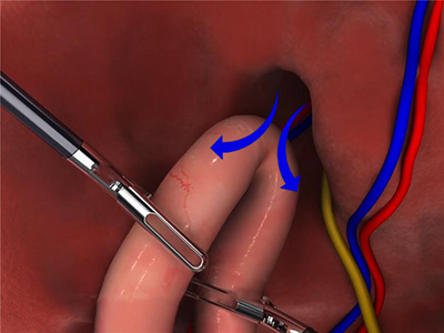 Laparoscopic Hernia Repair