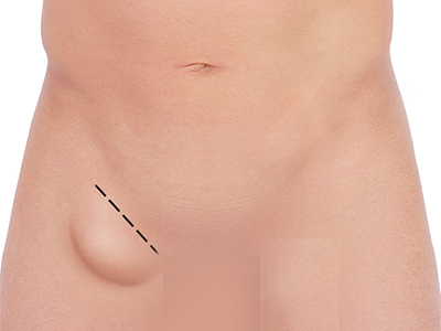 Open Hernia Surgery
