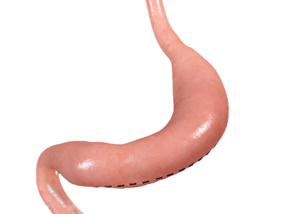 Sleeve Gastrectomy