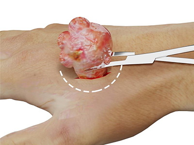 Soft Tissue Neoplasms