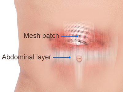 Ventral Hernia Repair