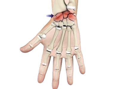 Arthritis of the Hand and Wrist