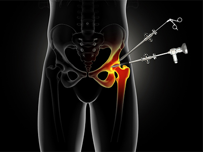 Arthroscopic Surgery