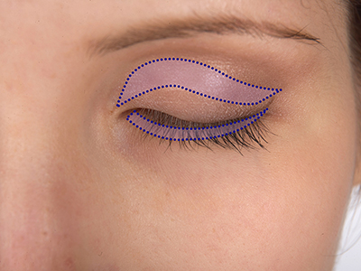 Blepharoplasty