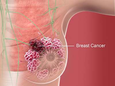 Breast Cancer