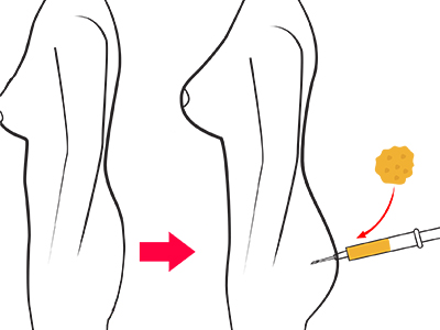 Buttocks lift and augmentation with autologous fat transfer