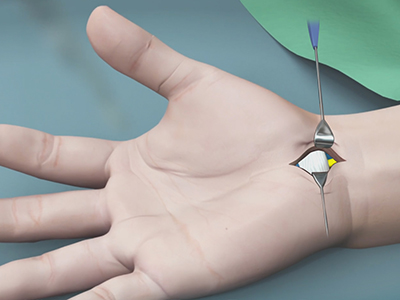 Carpal Tunnel Release Surgery