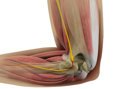 Cubital Tunnel Release (Medial Epicondylectomy)