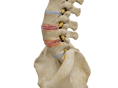 Degenerative Disc Disease