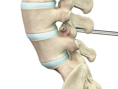 Degenerative Spine Surgery