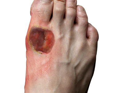 Diabetic Foot Conditions