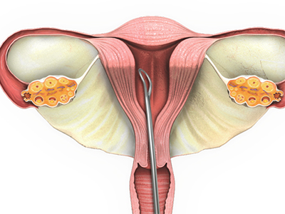 Dilation and Curettage
