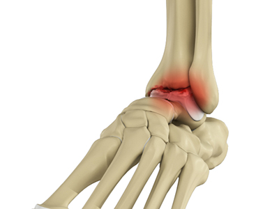 Foot and Ankle Arthritis