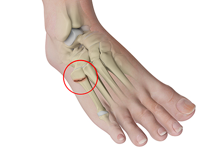 Foot Fracture