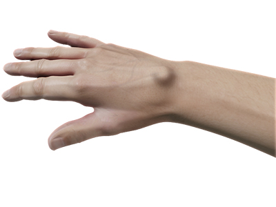 Ganglion Cyst