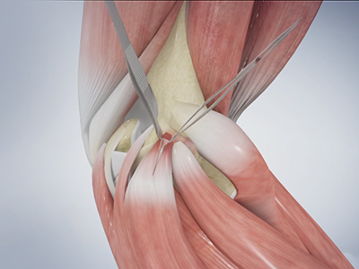 Golfer's Elbow Surgery