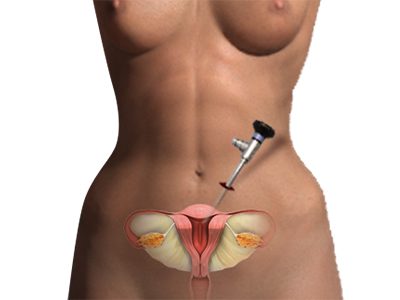 Gynaecological surgeries & Open Surgeries