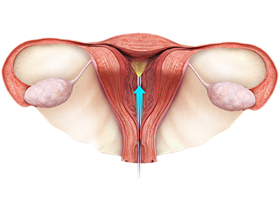 Hysteroscopy