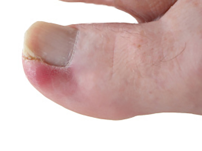 Ingrown toenail