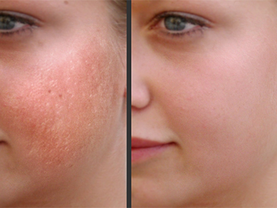 Laser Skin Resurfacing