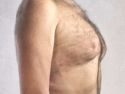 Male Breast Reduction