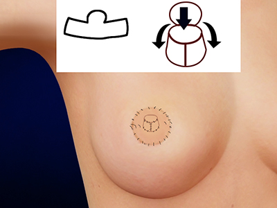 Nipple Reconstruction
