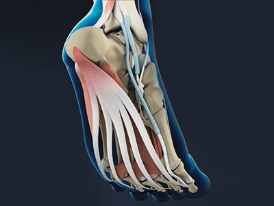 Plantar Fasciitis
