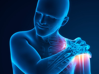 Post-traumatic Arthritis