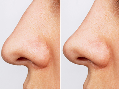 Rhinoplasty