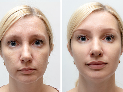 Skin Tightening or lift