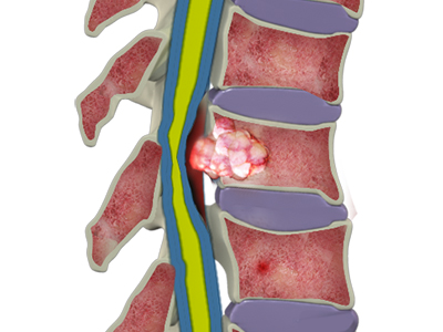 Spinal Tumors
