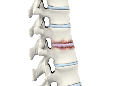 Spine Arthritis