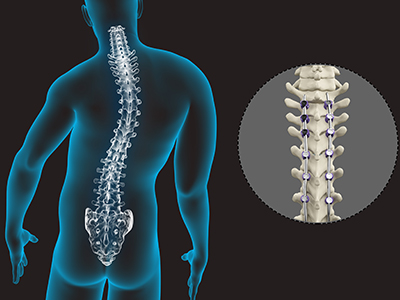 Spine Deformity Surgery