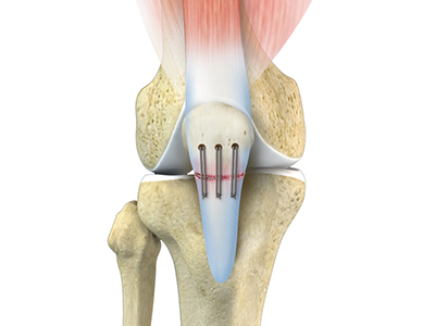 Tendon Repair Surgery