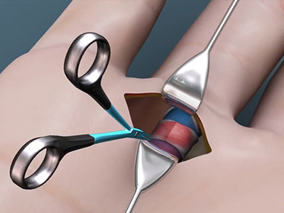 Trigger Finger Release