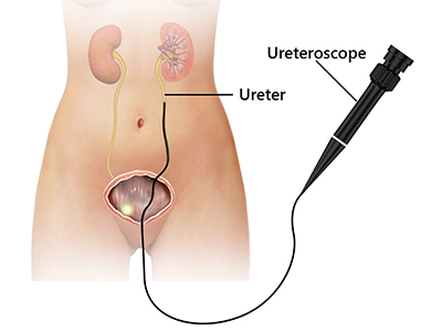 Ureteroscopy