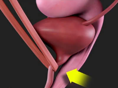 Urinary Incontinence Surgery in Women