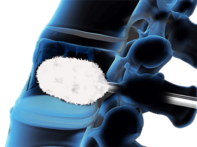 Vertebroplasty